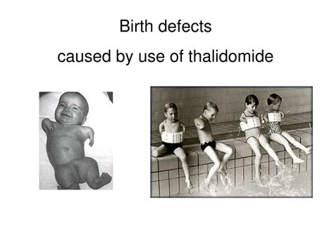 thalidomide birth defects